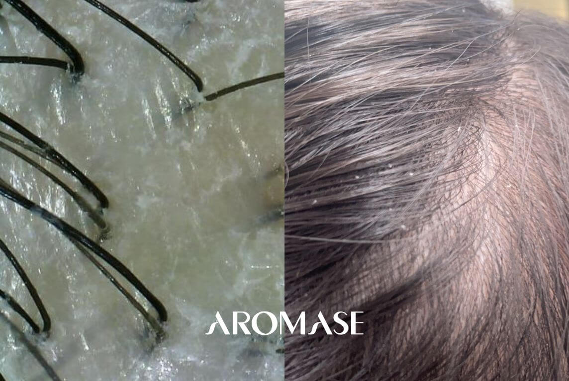 5 Quick Questions to Check for Dry and Flaky Scalp AROAMSE scalp care 3