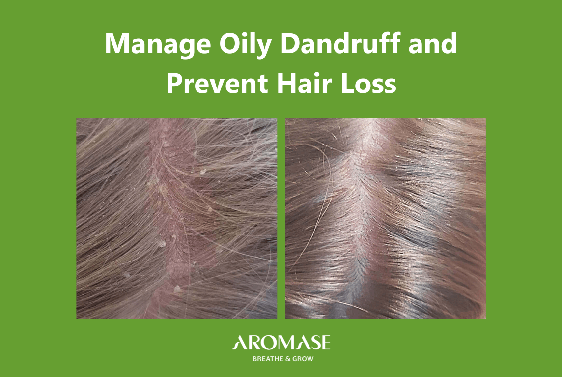 AROMASE oily dandruff and hair loss_4 connections (1)