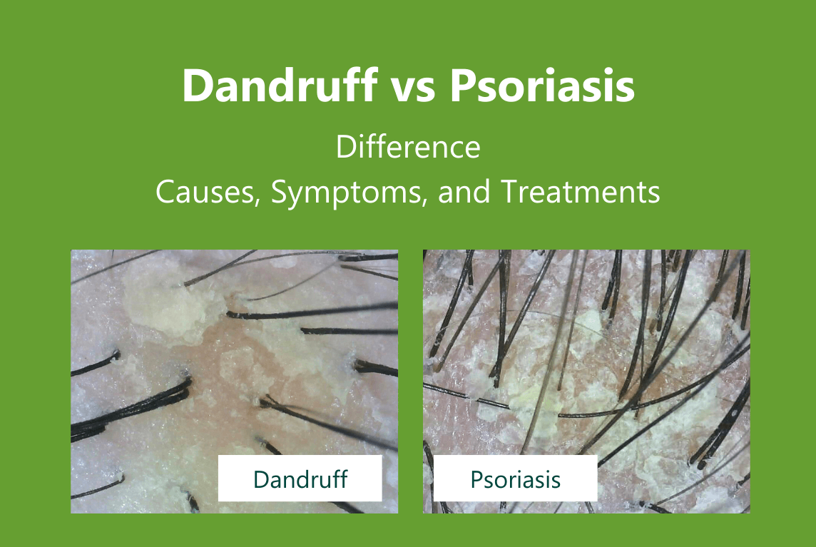 AROMASE Scalp Psoriasis vs Dandruff: Differences, Pictures, Symptoms & Herbal Treatments