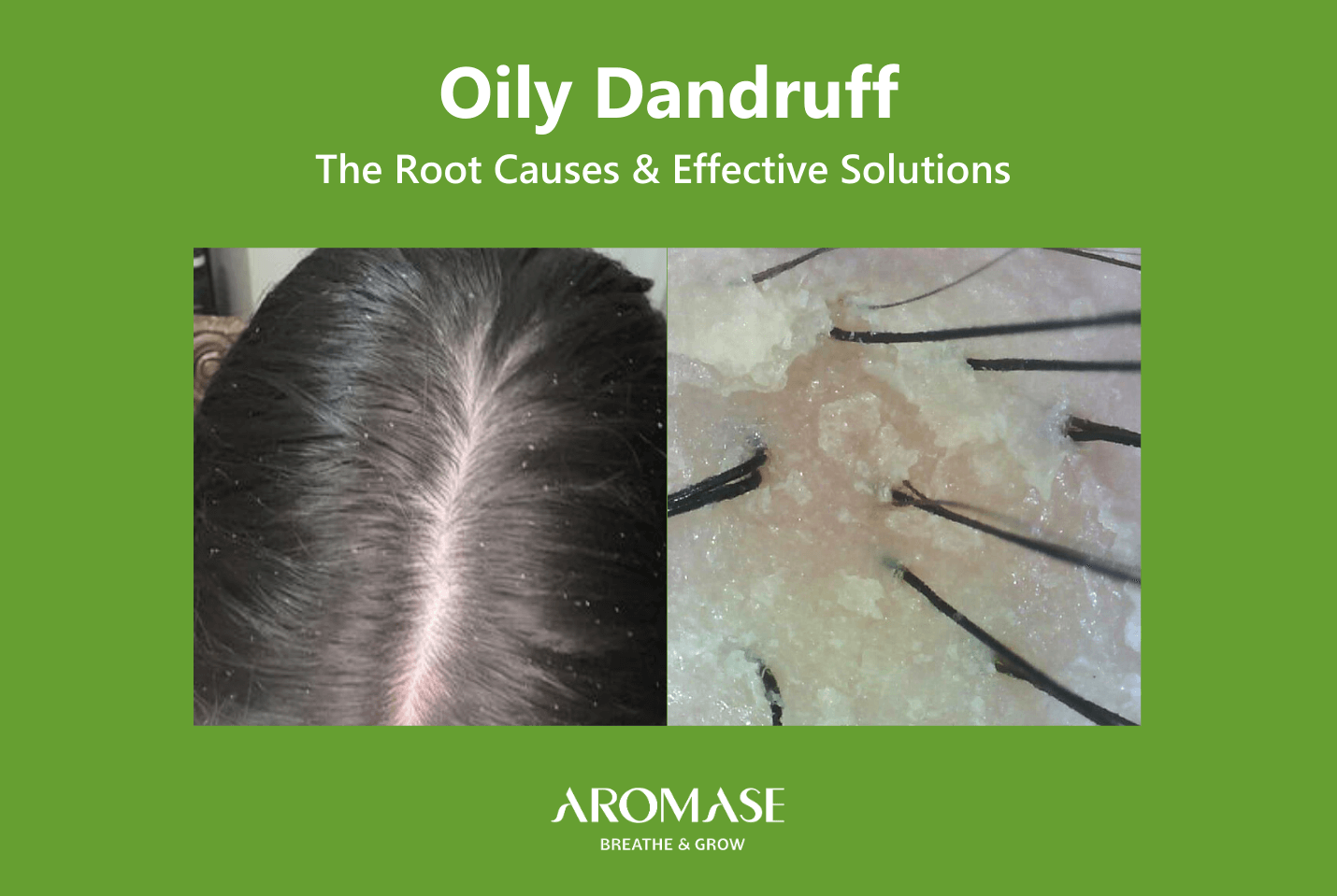 AROMASE_scalp care_Oily Dandruff The Root Causes and Effective Solution (4)