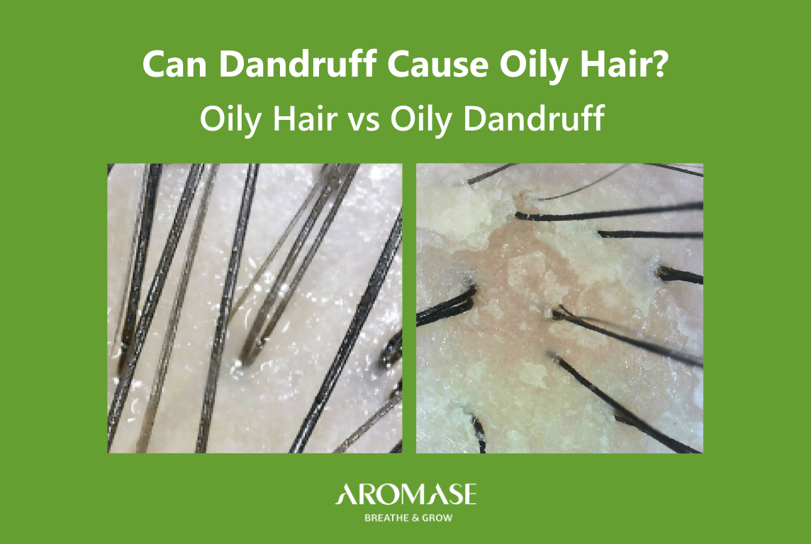 AROMASE_scalp care_The diffrence between Oily Hair and Oily Dandruff (1)