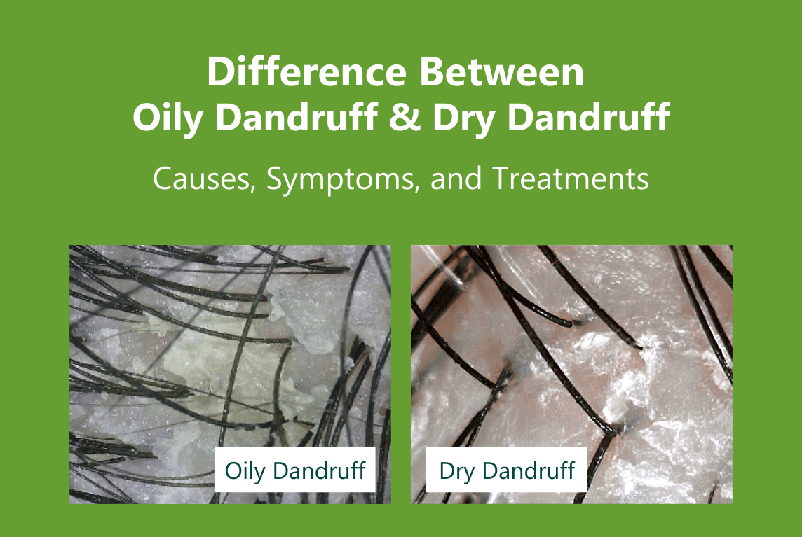 Differences between OILY Dandruff and DRY Dandruff Causes, Symptoms, Photos, and Treatments AROMASE at home scalp care