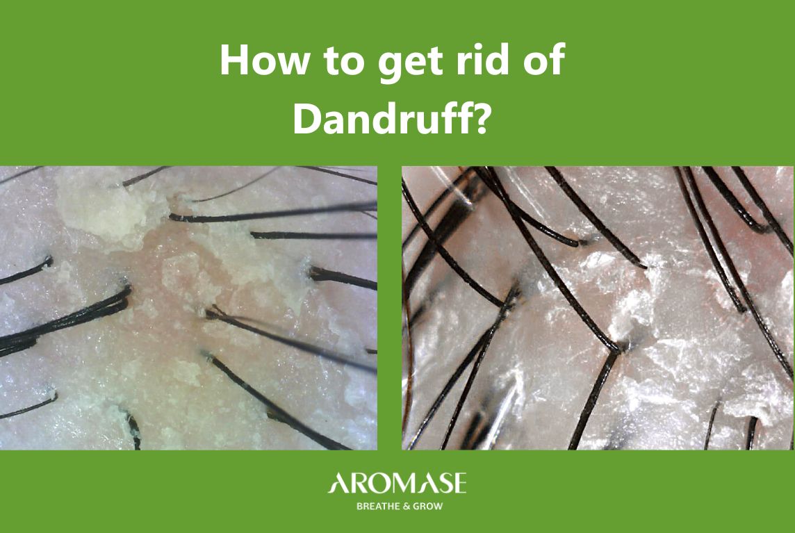 How to Get Rid of Dandruff Summer Tips for Oily Dandruff & Dry Dandruff AROMASE scalp care tips