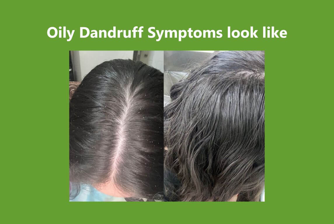 Oily Dandruff Sufferer 2-Year Journey and Solution Reviews AROMASE scalp care