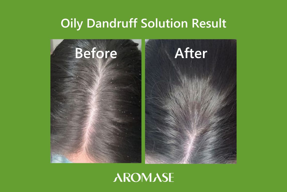 Oily Dandruff Sufferer 2-Year Journey and Solution Reviews AROMASE scalp care_2