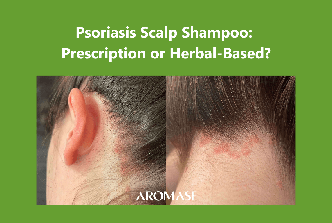 Psoriasis Scalp Shampoo Prescription or Herbal-Based AROMASE