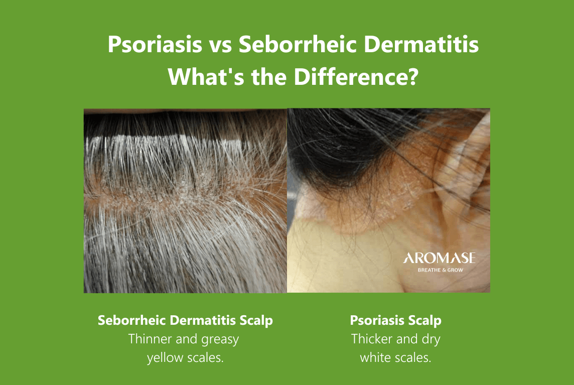 Psoriasis vs Seborrheic Dermatitis What's the Difference_AROMSE_scalp treatment