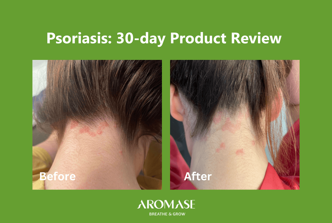 Scalp Psoriasis Solutions 30-Day Transformation AROMASE case study (1)