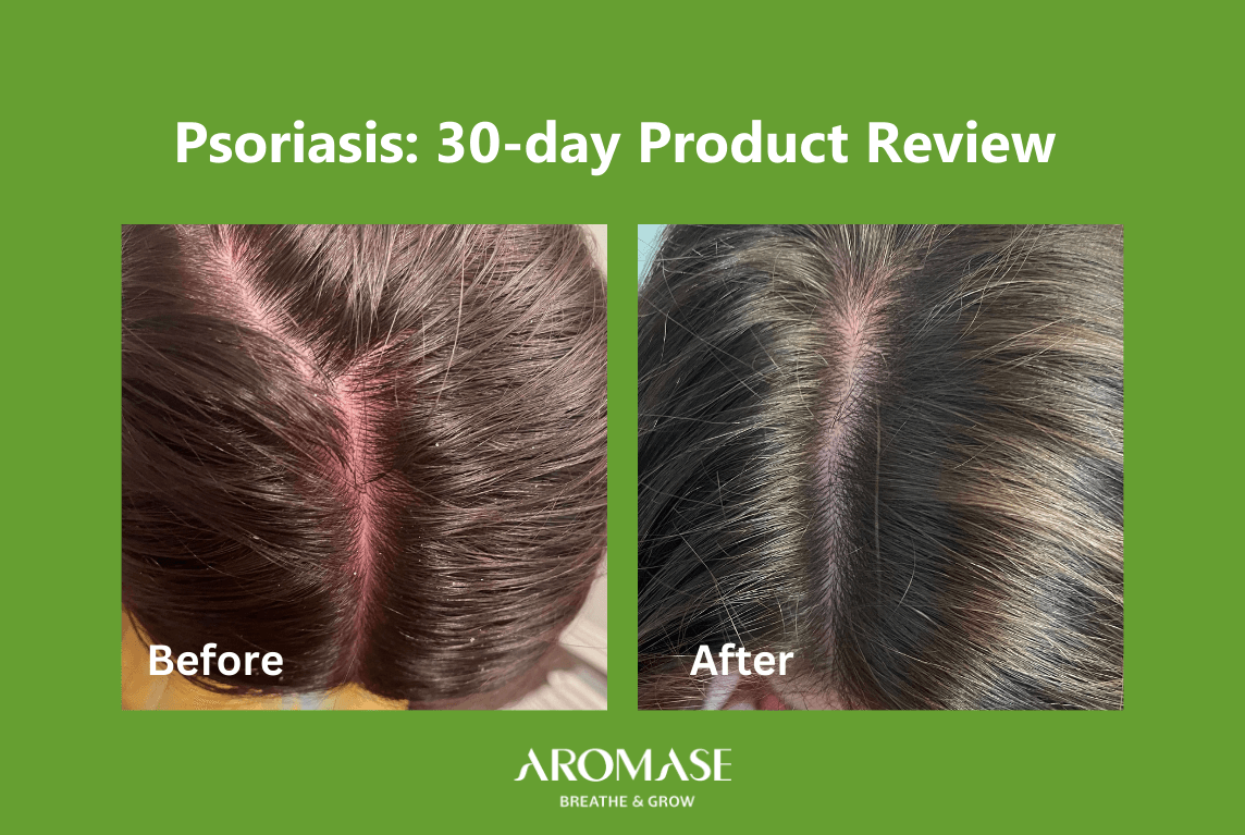 Scalp Psoriasis Solutions 30-Day Transformation AROMASE case study (2)