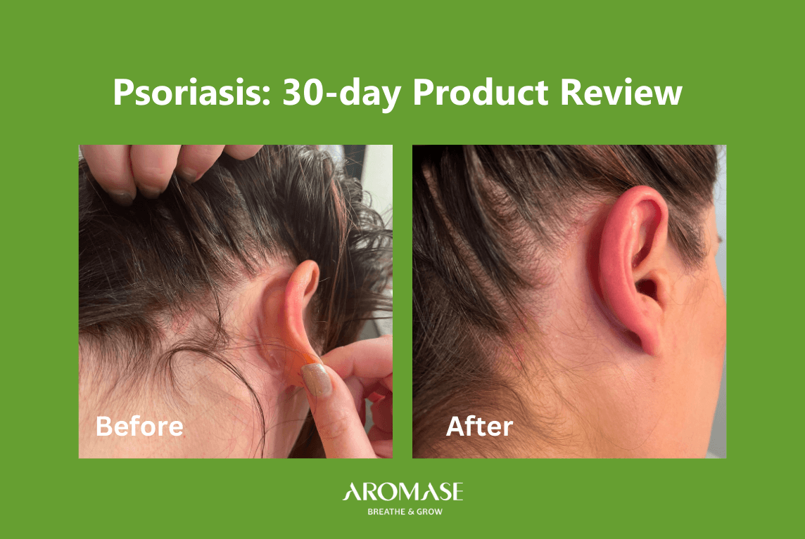 Scalp Psoriasis Solutions 30-Day Transformation AROMASE case study (3)