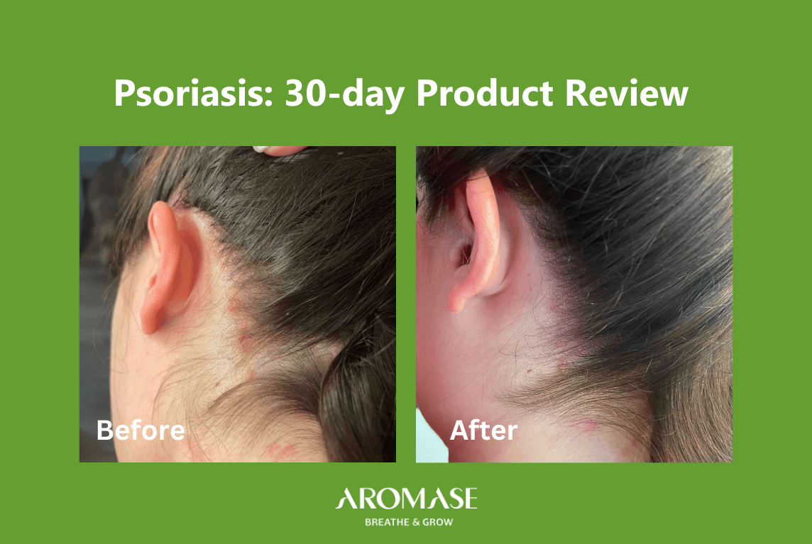 Scalp Psoriasis Solutions 30-Day Transformation AROMASE case study (4)