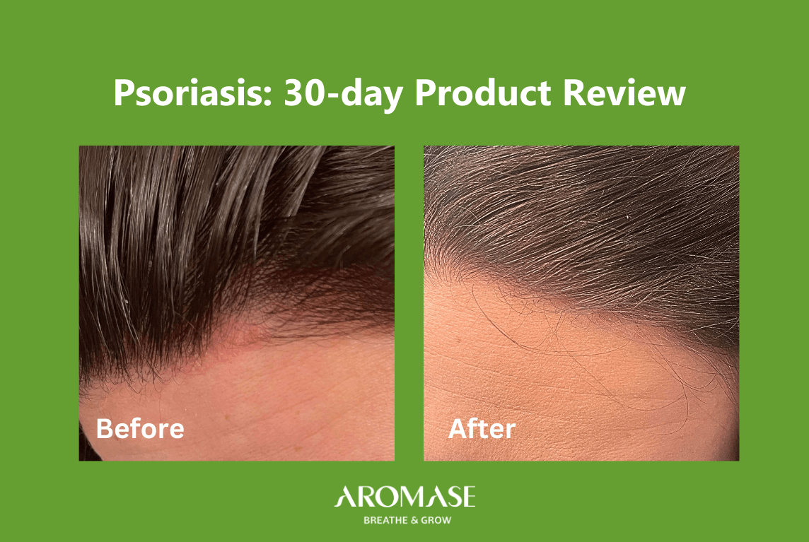 Scalp Psoriasis Solutions 30-Day Transformation AROMASE case study (5)