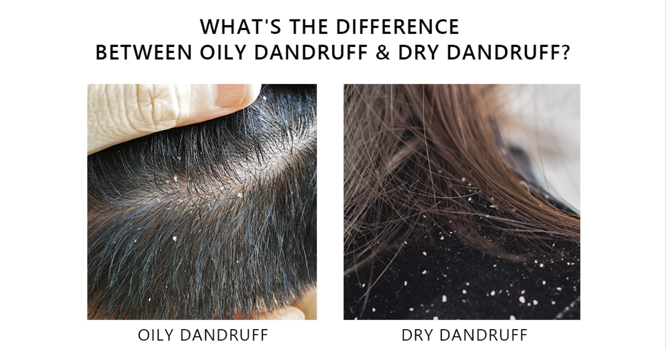 OILY Dandruff vs. DRY Dandruff Learn the Causes & Differences AROMASE